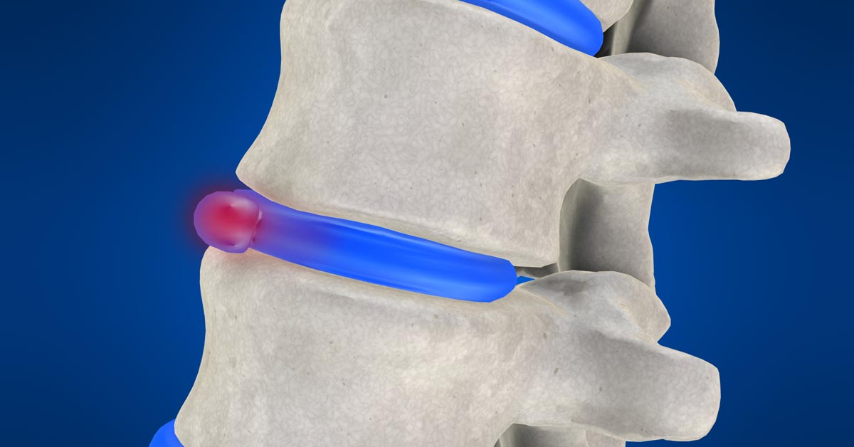 Nashville non-surgical disc herniation treatment